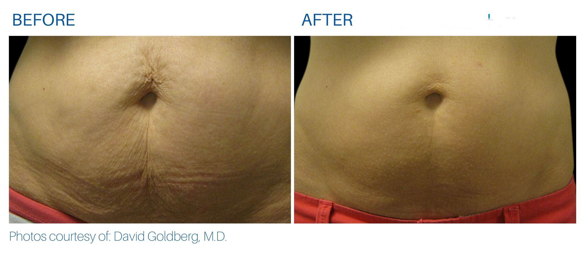 Before and after radio-frequency fat reduction in Corpus Christi