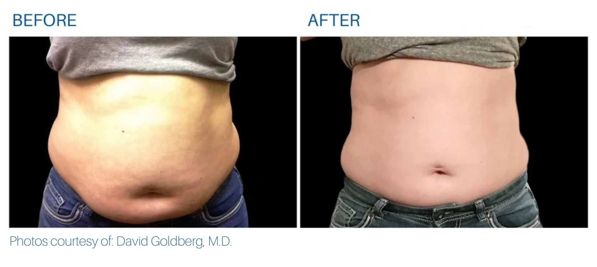 Radio-frequency fat-reduction before and after in Corpus Christi