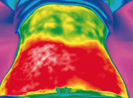 Radio frequency fat reduction heat radients in Corpus Christi