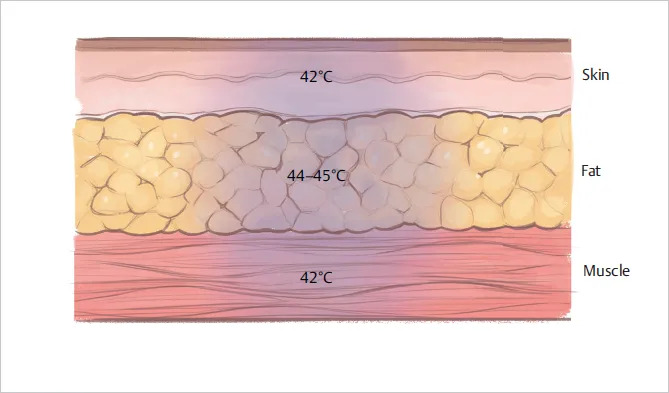 Radio frequency fat reduction layers temperature in Corpus Christi