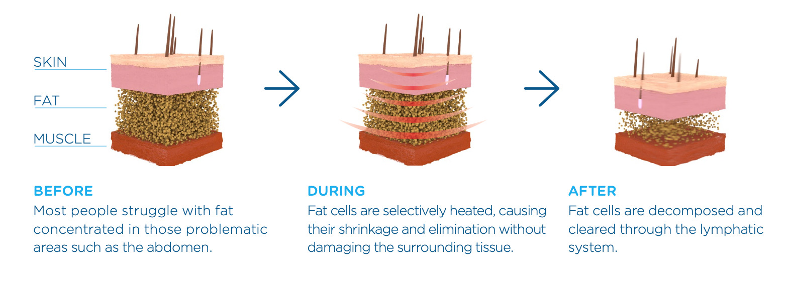 RF Non-Invasive Fat Removal