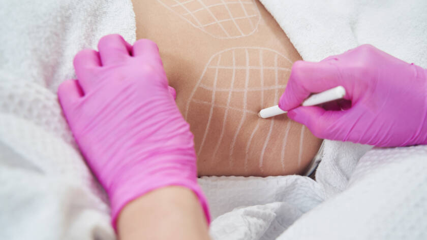 Body Sculpting Fat Removal Options in Corpus Christi