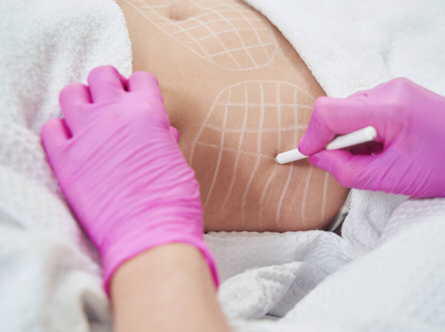 Body Sculpting Fat Removal Options in Corpus Christi