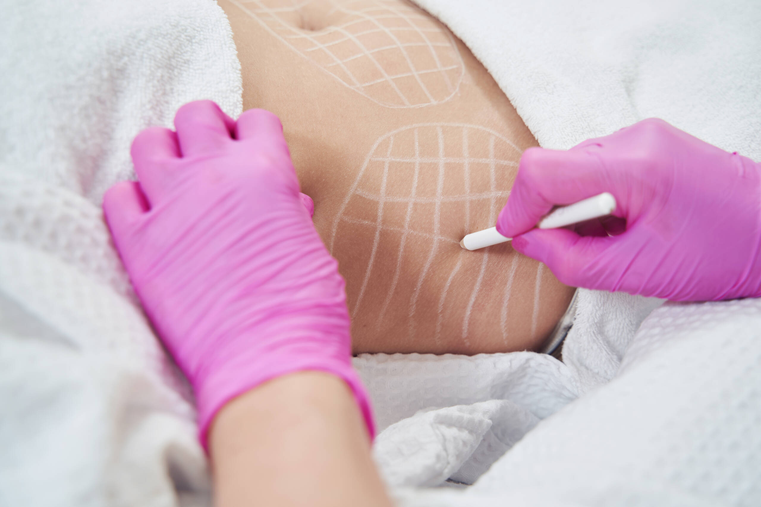 Body Sculpting Fat Removal Options in Corpus Christi